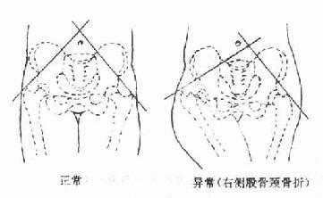 Kaplan氏点