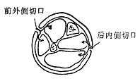 小腿两个皮肤切口,切开四个筋膜间室减压示意图