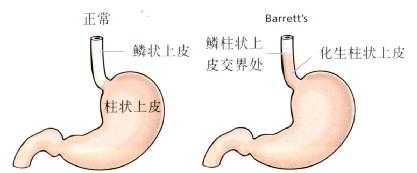 Barrett食管