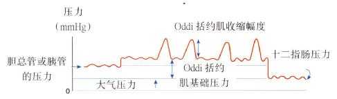 与测压记录相关的Oddi括约肌压力示意