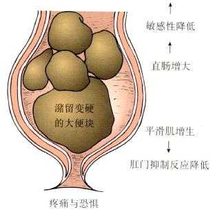巨直肠病理生理学