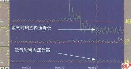 近端压力通道位于膈肌上方,图示吸气时压力下降