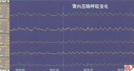所有通道均在胃内时的压力曲线