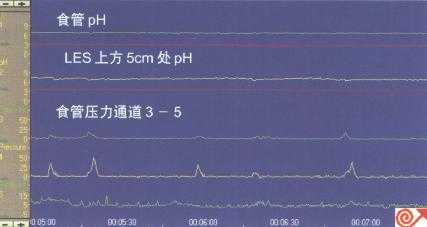 一例食管pH及动力联合检测