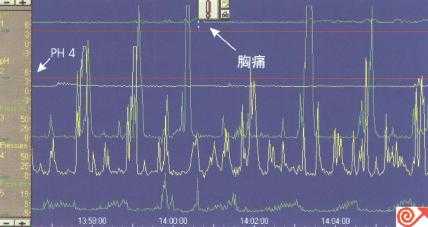 一例食管pH及动力联合检测