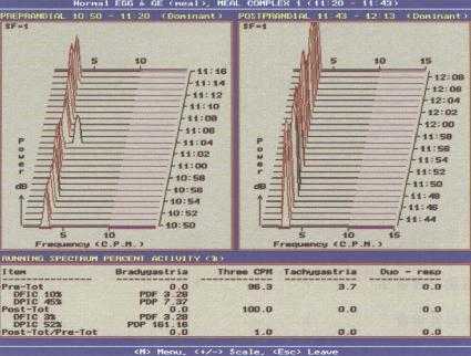 快速富里叶(Fourier)分析法进行EGG检查图例