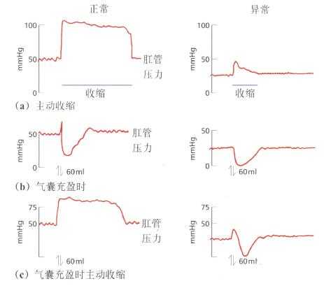 一例肛门外括约肌功能减弱患儿与正常儿童肛门直肠测压