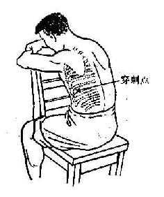 坐位时胸腔穿刺点