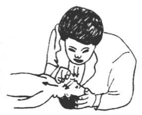 口对口鼻人工呼吸法