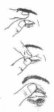 单手上睑翻转法