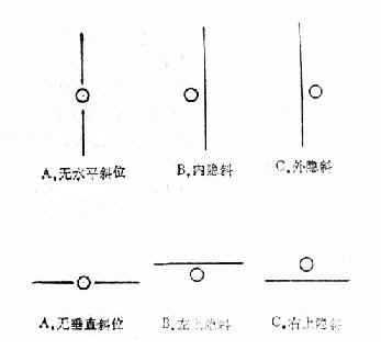 检查结果(马氏杆置右眼前)