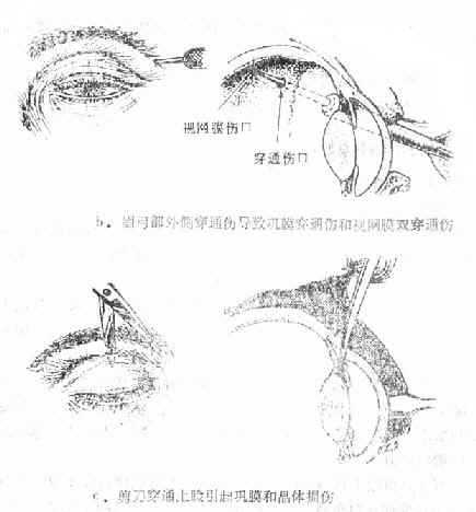 眼球穿孔伤