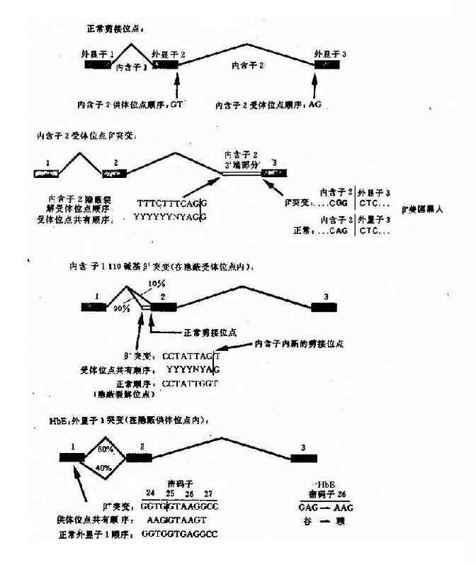 干扰正常β珠蛋白剪接的突变举例