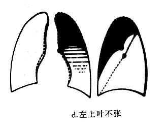 各肺叶肺不张