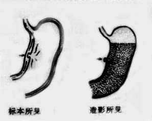 胃小弯溃疡示意图