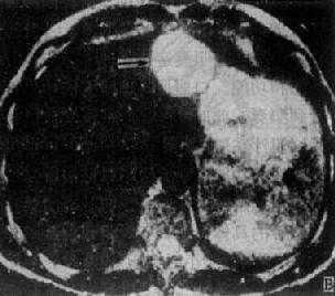 肝血管瘤(MRI)