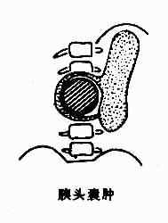 胰腺囊肿