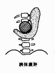 胰腺囊肿