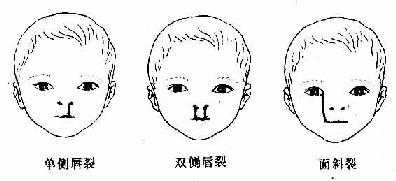 颜面畸形