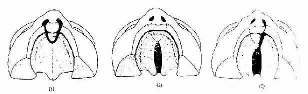 腭裂
