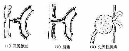 肠管先天性畸形