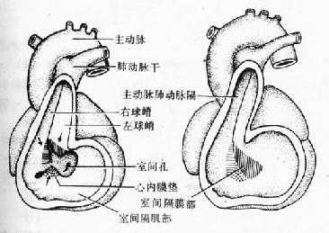 室间隔膜部的形成及室间孔封闭