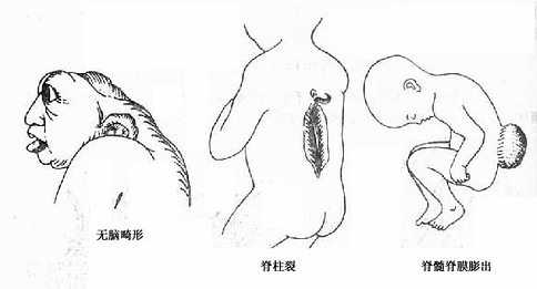 神经系统的几种畸形